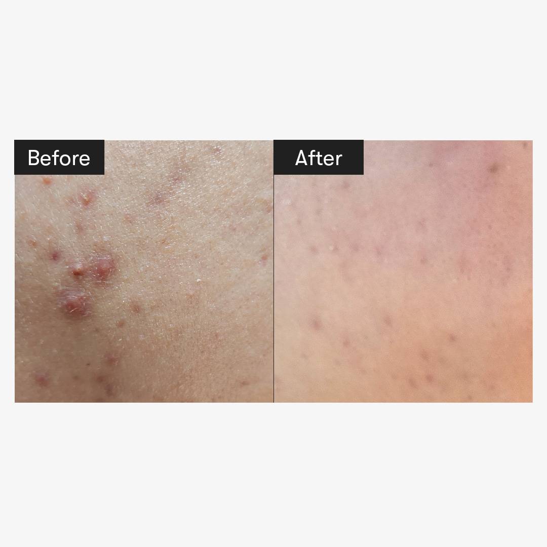 VT Reedle Shot 100 before and after skin comparison