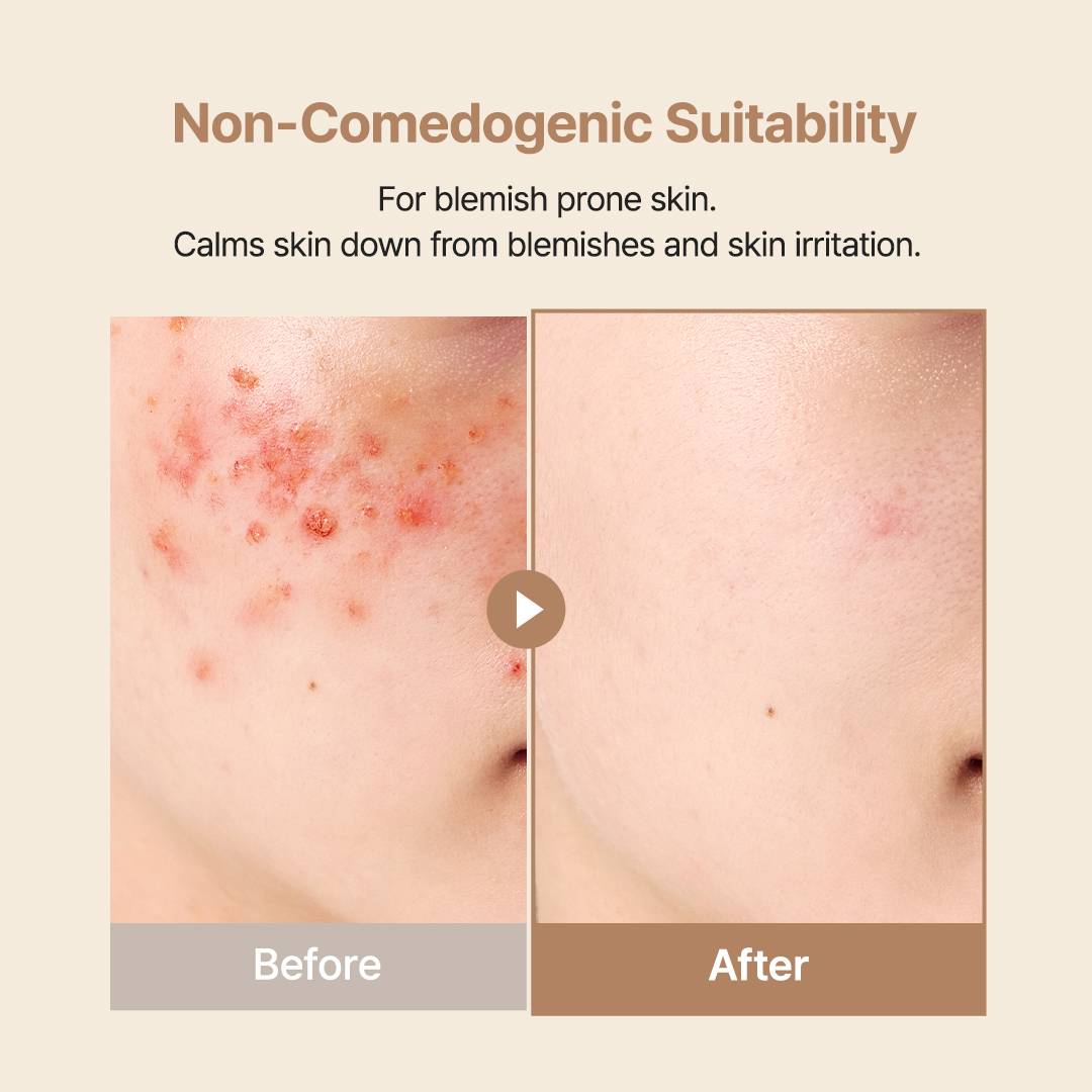 Purito Oat In Calming Gel Cream non-comedogenic for blemish-prone skin, before and after